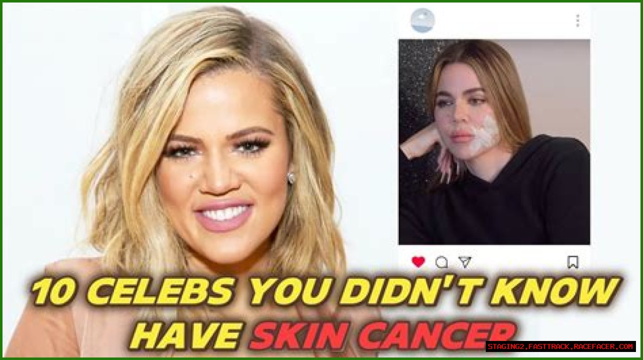 Unveiling The Tragic Tales: Celebrities Lost To Melanoma
